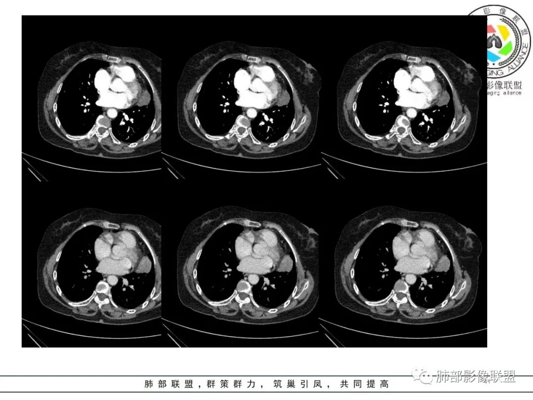 影像PPT - 【病例】肺内孤立性纤维瘤1例CT影像诊断要点-41 影像PPT - 【病例】肺内孤立性纤维瘤1例CT影像诊断要点-41