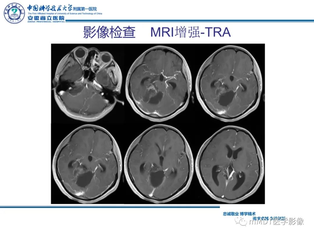 影像PPT - 【PPT】毛细胞型星形细胞瘤病例解析-8