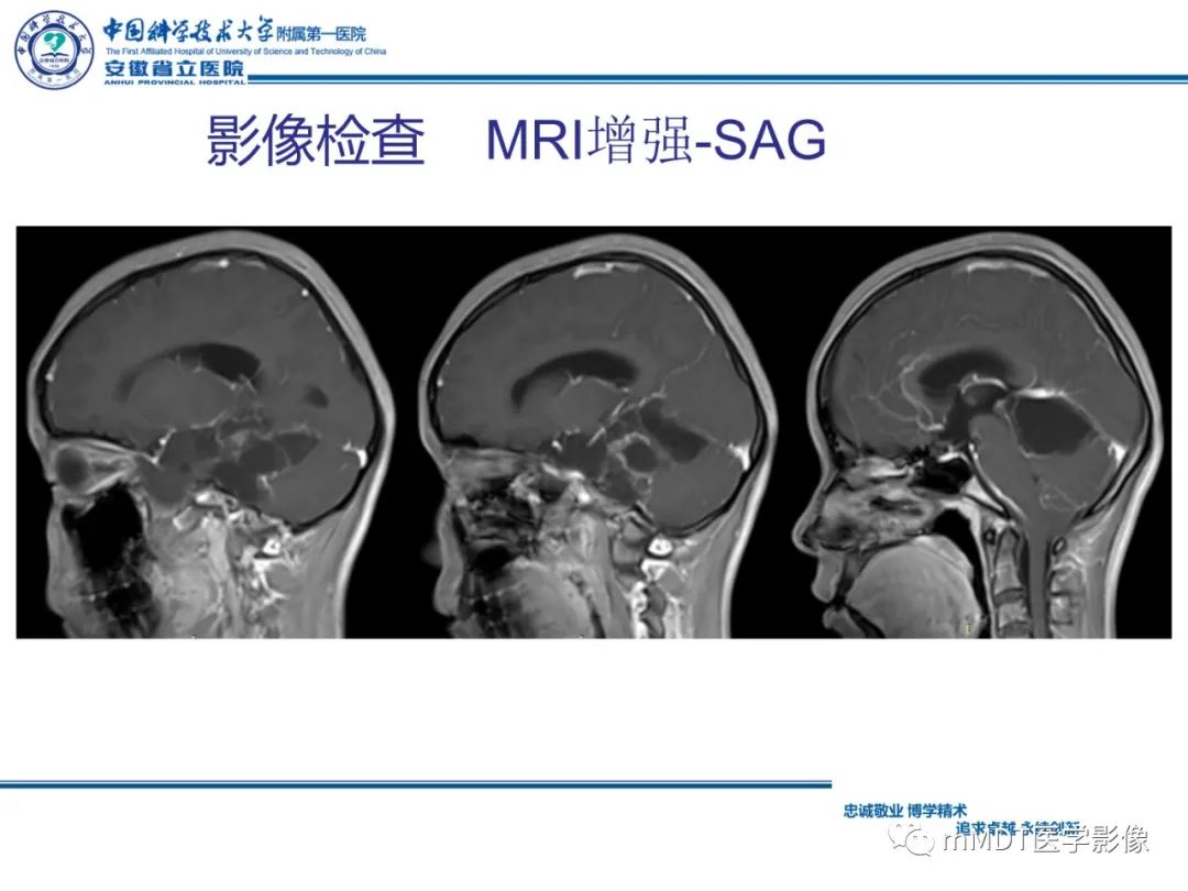 影像PPT - 【PPT】毛细胞型星形细胞瘤病例解析-9
