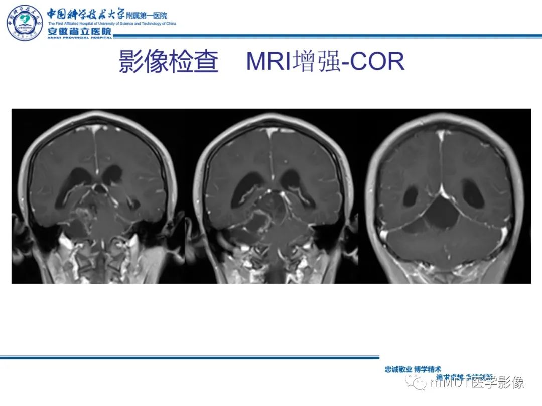 影像PPT - 【PPT】毛细胞型星形细胞瘤病例解析-10