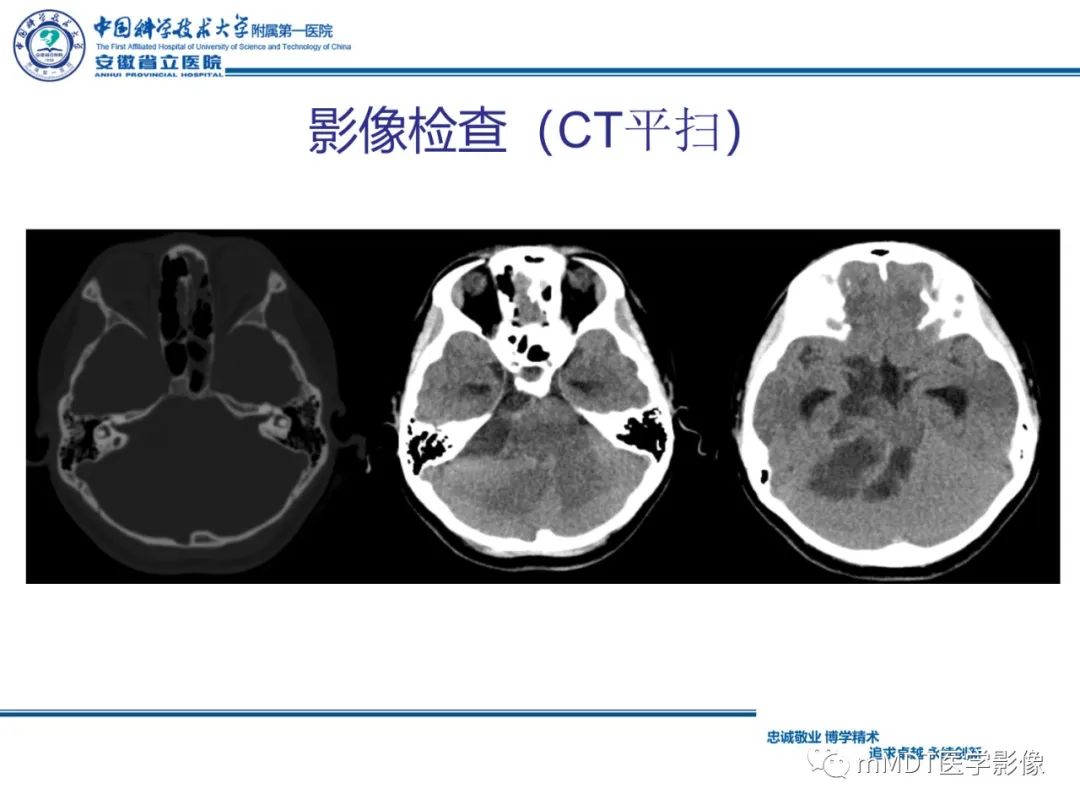 影像PPT - 【PPT】毛细胞型星形细胞瘤病例解析-4