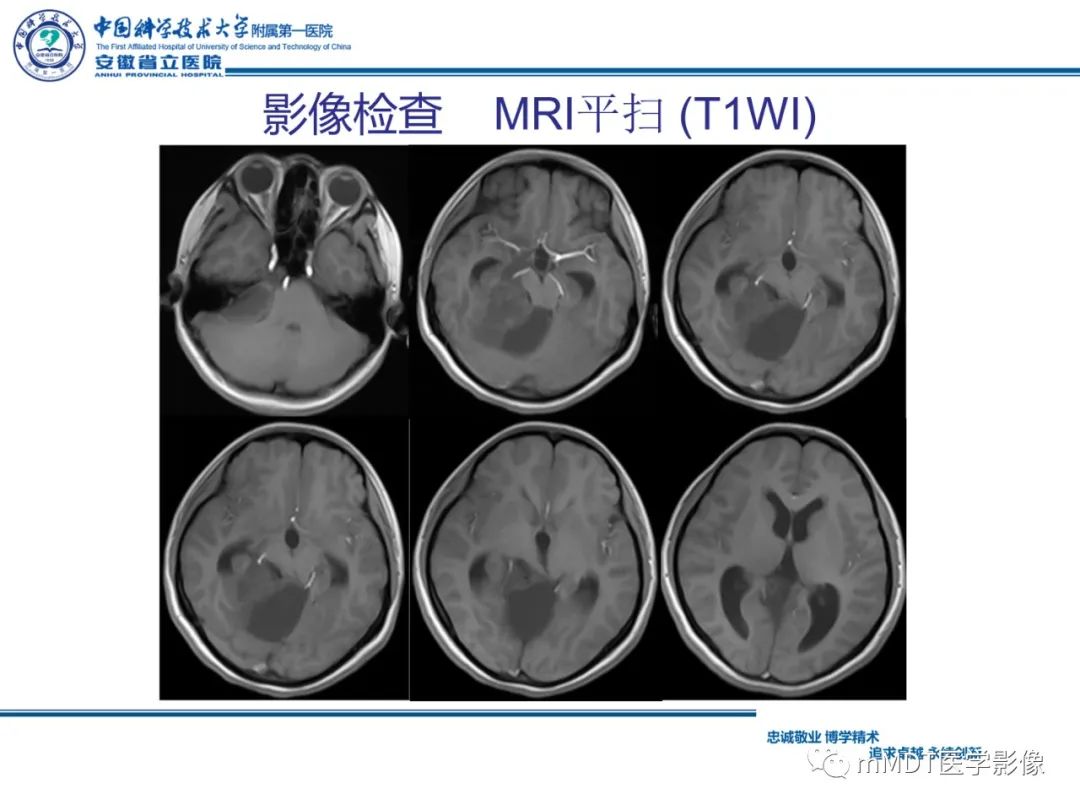 影像PPT - 【PPT】毛细胞型星形细胞瘤病例解析-7
