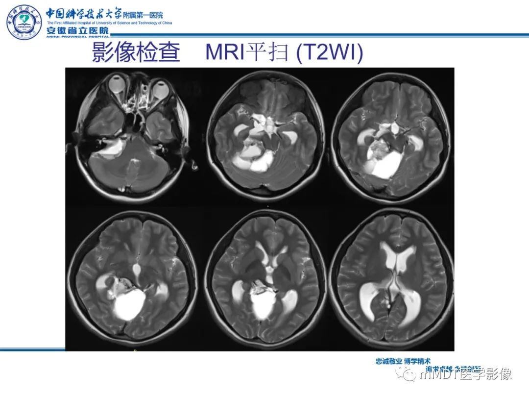 影像PPT - 【PPT】毛细胞型星形细胞瘤病例解析-6
