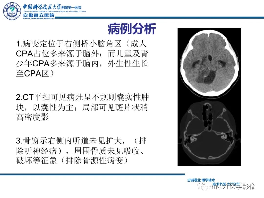 影像PPT - 【PPT】毛细胞型星形细胞瘤病例解析-13