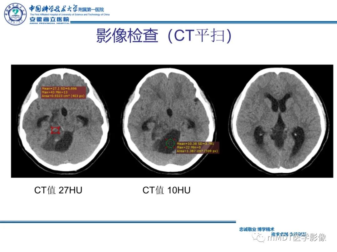 影像PPT - 【PPT】毛细胞型星形细胞瘤病例解析-5