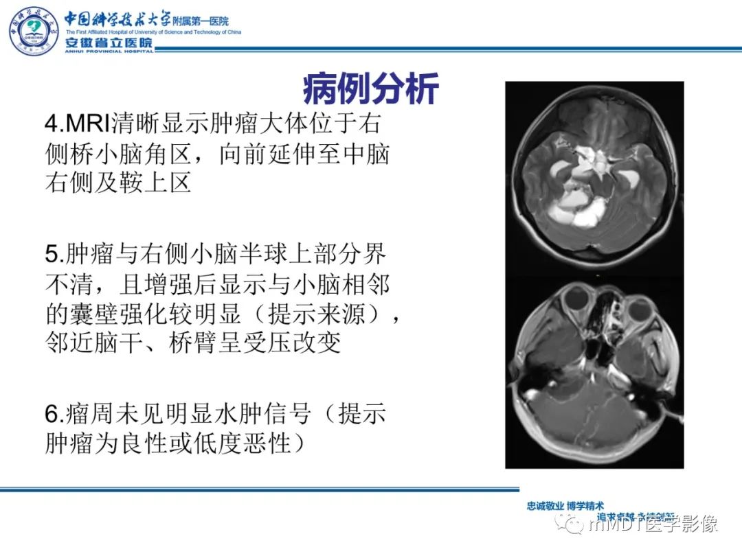 影像PPT - 【PPT】毛细胞型星形细胞瘤病例解析-14