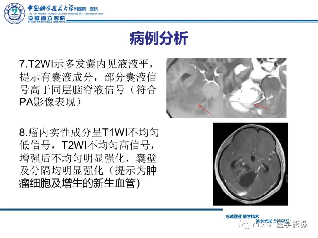 影像PPT - 【PPT】毛细胞型星形细胞瘤病例解析-15