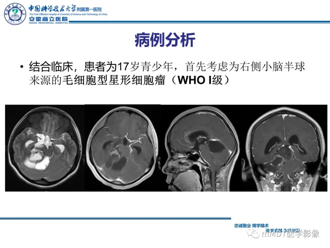 影像PPT - 【PPT】毛细胞型星形细胞瘤病例解析-16