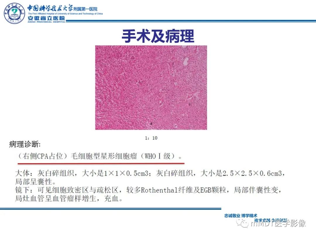 影像PPT - 【PPT】毛细胞型星形细胞瘤病例解析-18