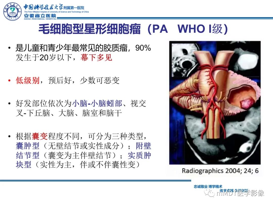 影像PPT - 【PPT】毛细胞型星形细胞瘤病例解析-19