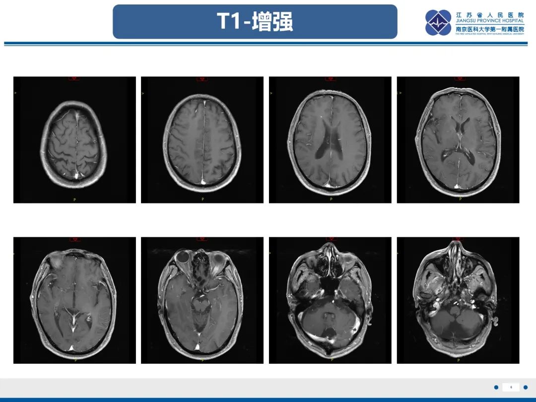 影像PPT - 【PPT】橄榄体脑桥小脑萎缩-7