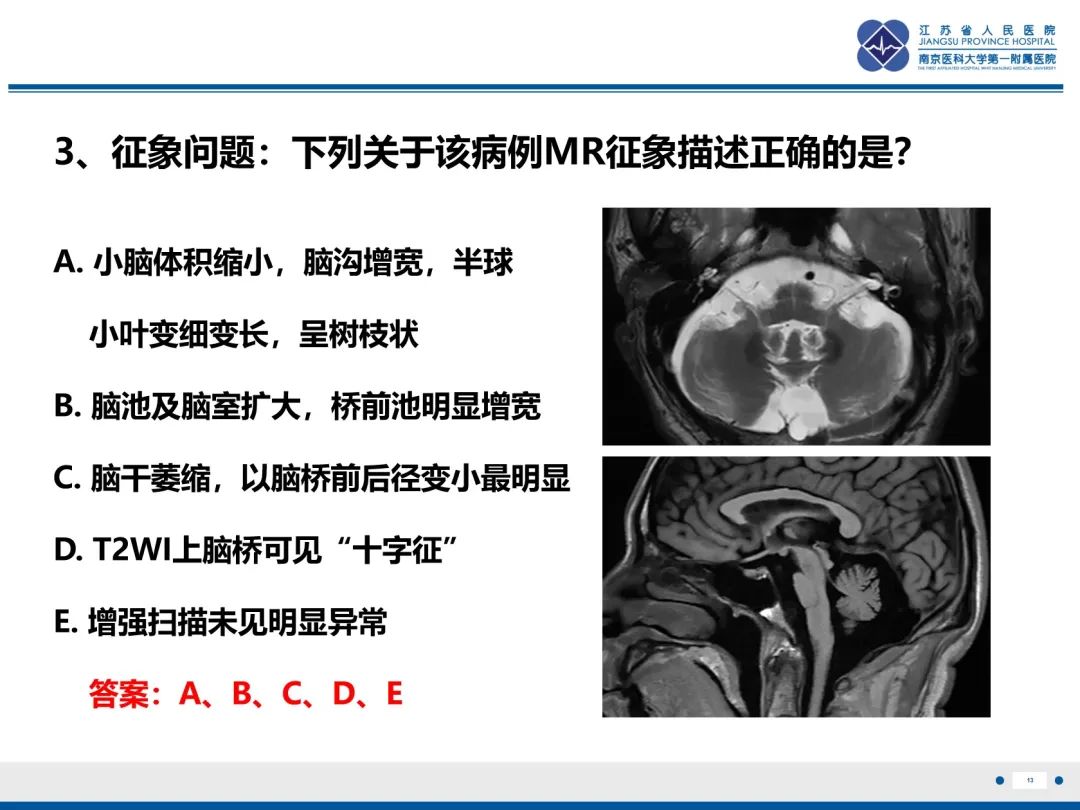 影像PPT - 【PPT】橄榄体脑桥小脑萎缩-14