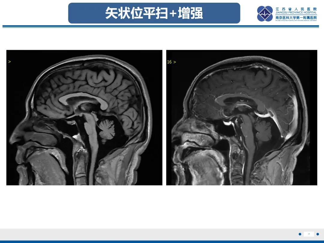 影像PPT - 【PPT】橄榄体脑桥小脑萎缩-8