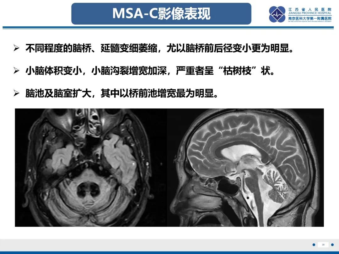 影像PPT - 【PPT】橄榄体脑桥小脑萎缩-24