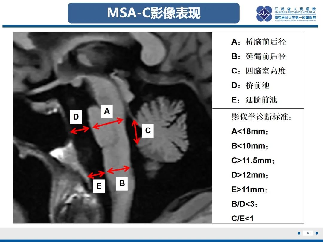 影像PPT - 【PPT】橄榄体脑桥小脑萎缩-25