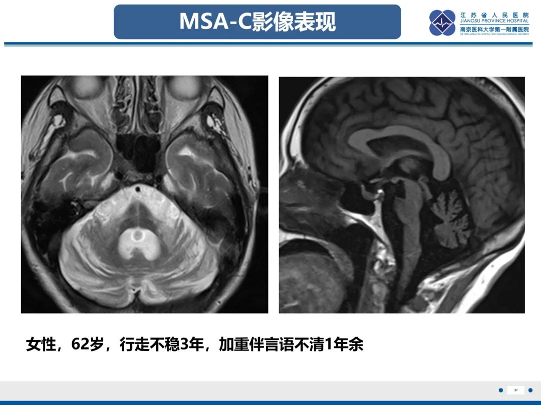 影像PPT - 【PPT】橄榄体脑桥小脑萎缩-28