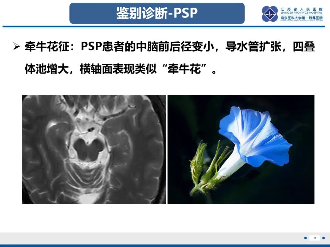 影像PPT - 【PPT】橄榄体脑桥小脑萎缩-35