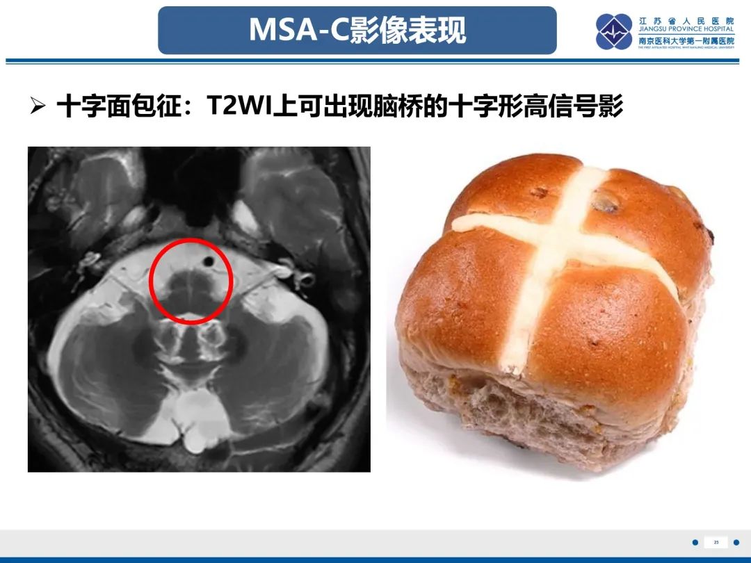 影像PPT - 【PPT】橄榄体脑桥小脑萎缩-26