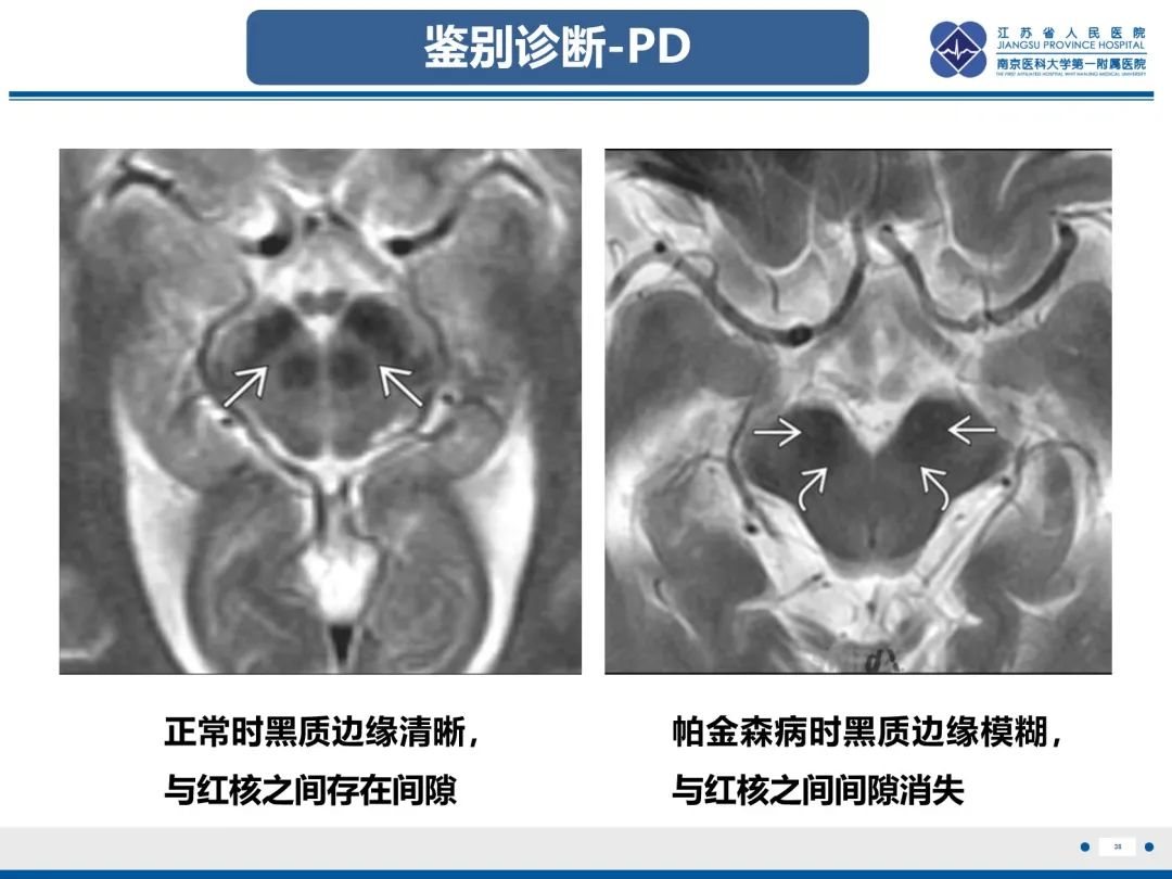 影像PPT - 【PPT】橄榄体脑桥小脑萎缩-39