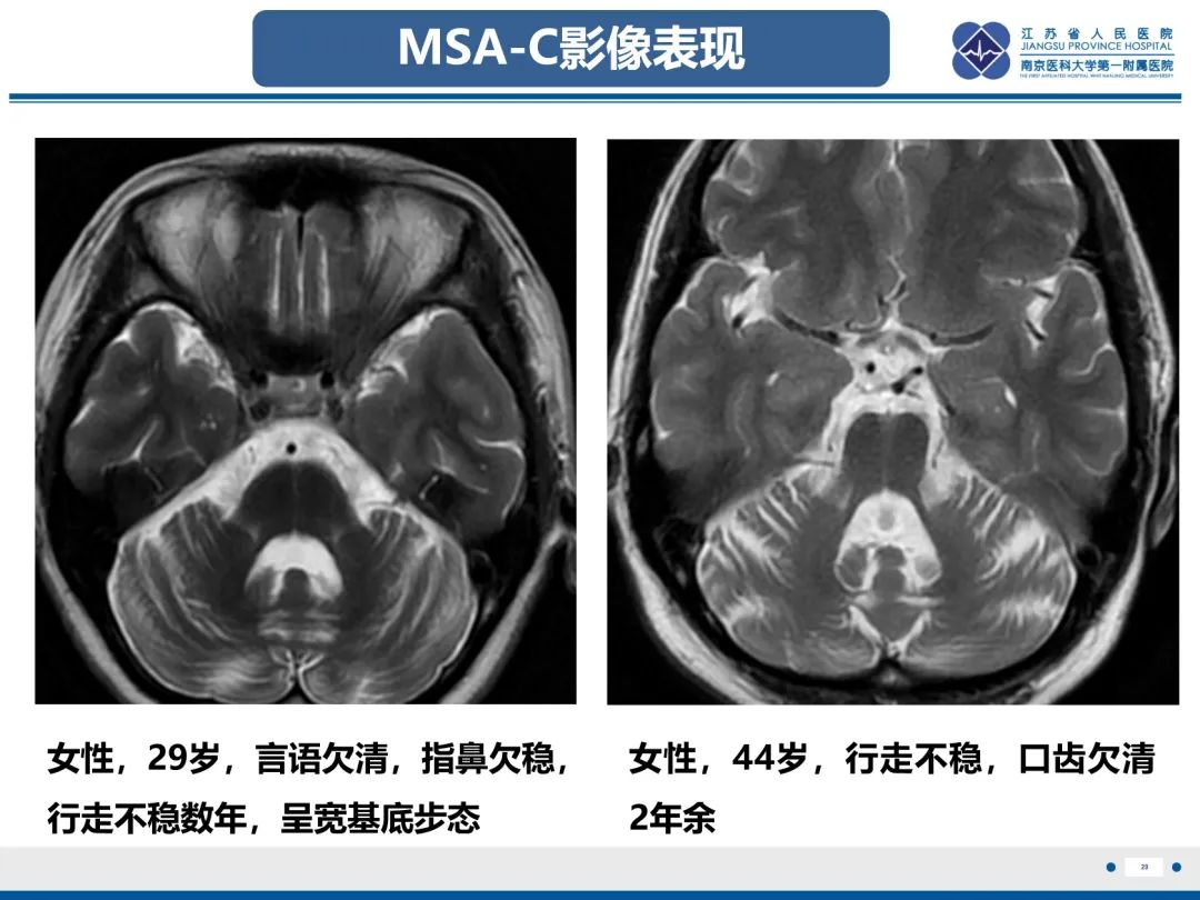 影像PPT - 【PPT】橄榄体脑桥小脑萎缩-30