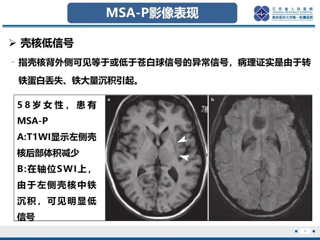 影像PPT - 【PPT】橄榄体脑桥小脑萎缩-32