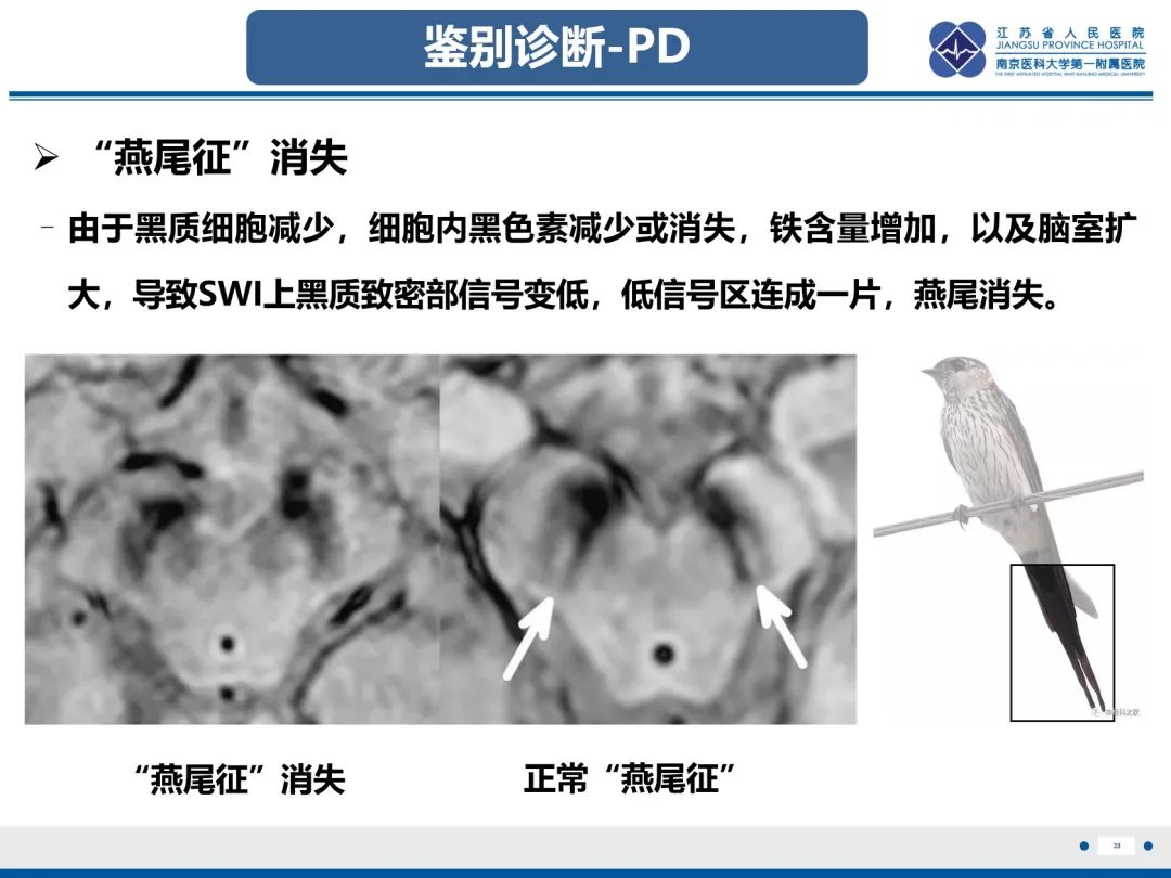 影像PPT - 【PPT】橄榄体脑桥小脑萎缩-40