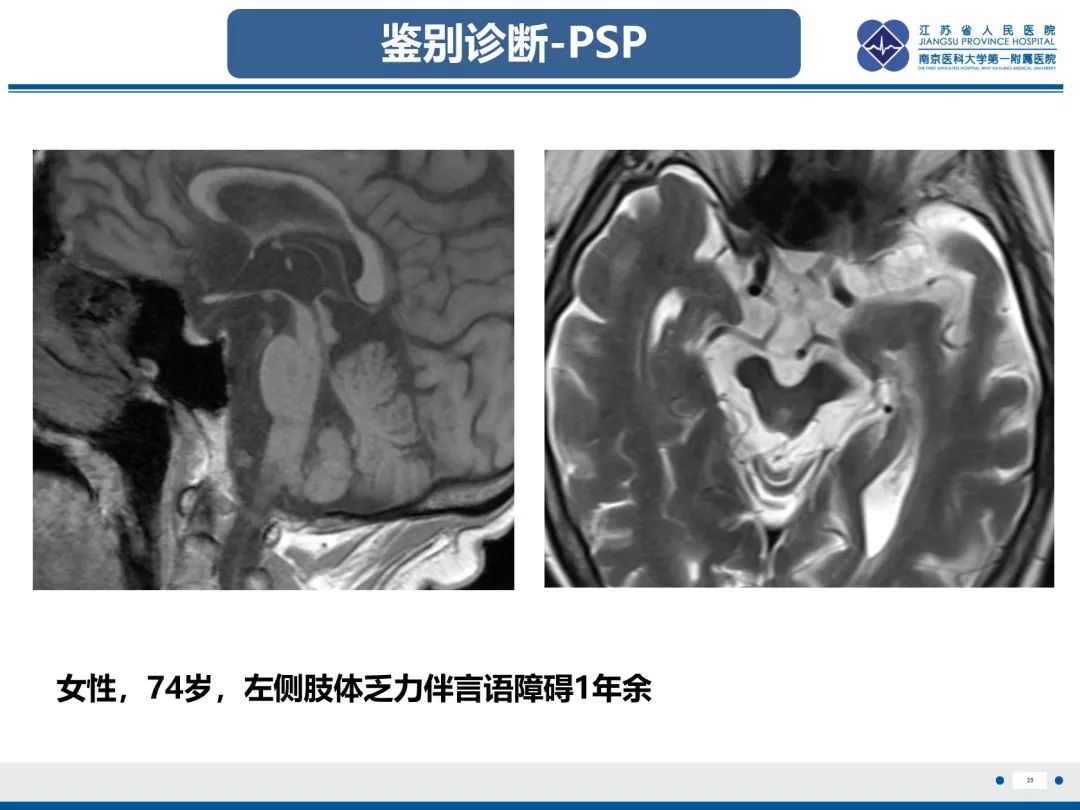 影像PPT - 【PPT】橄榄体脑桥小脑萎缩-36