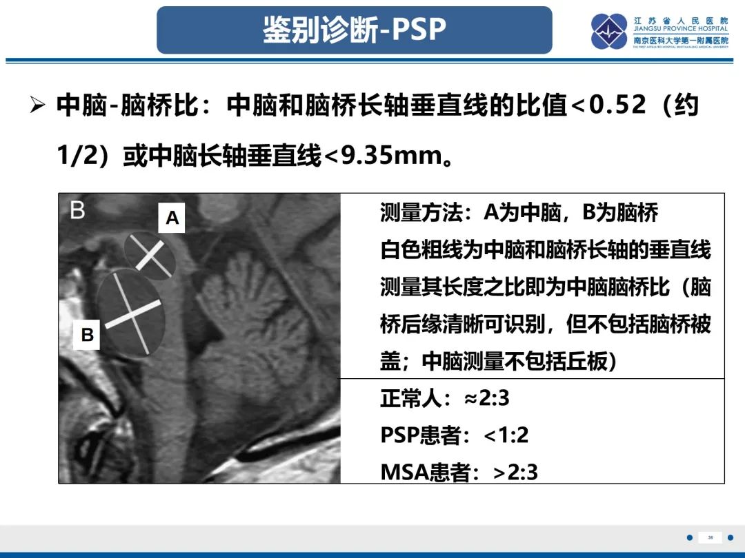 影像PPT - 【PPT】橄榄体脑桥小脑萎缩-37