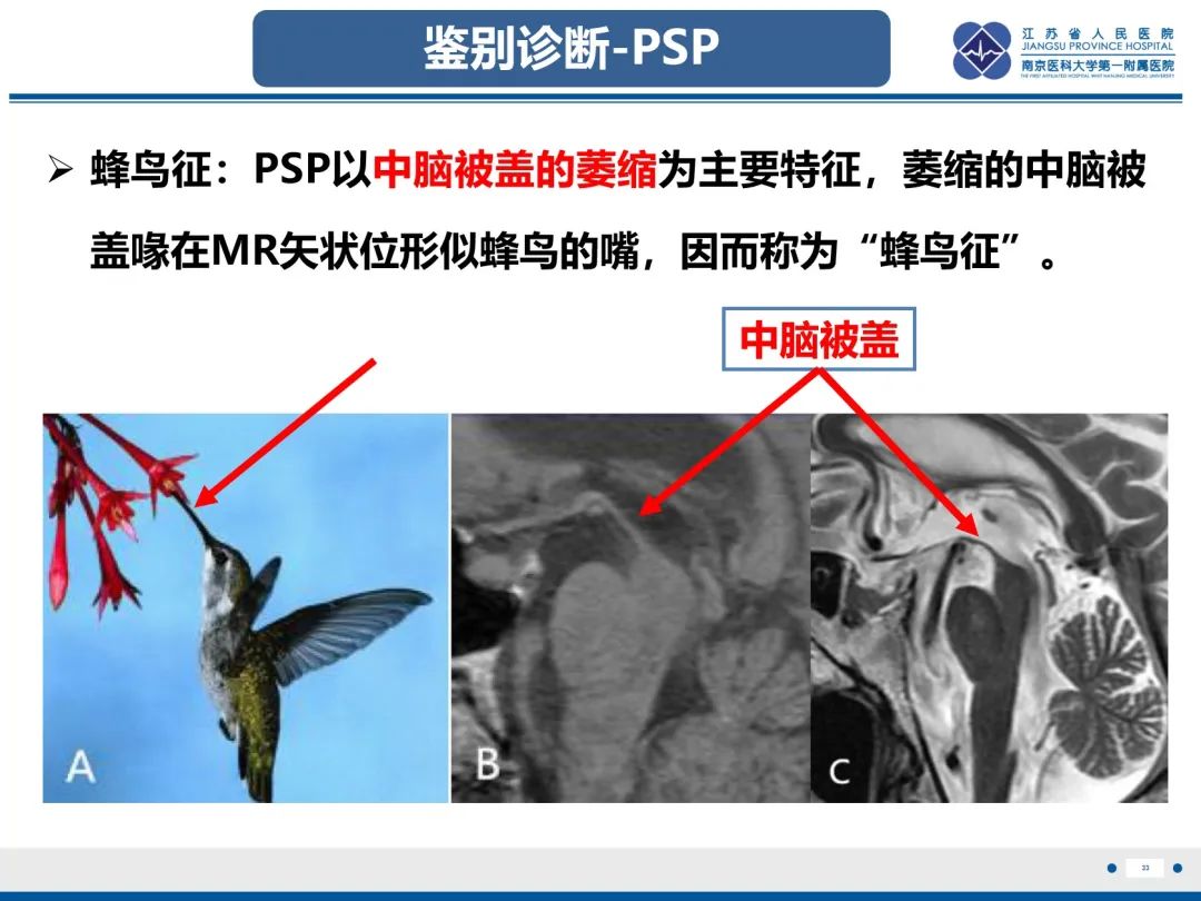 影像PPT - 【PPT】橄榄体脑桥小脑萎缩-34