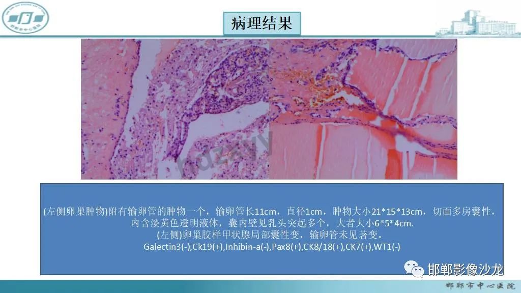 影像PPT - 【PPT】卵巢甲状腺肿-10 影像PPT - 【PPT】卵巢甲状腺肿-10