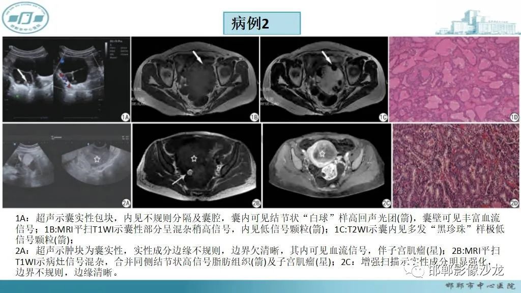 影像PPT - 【PPT】卵巢甲状腺肿-20 影像PPT - 【PPT】卵巢甲状腺肿-20