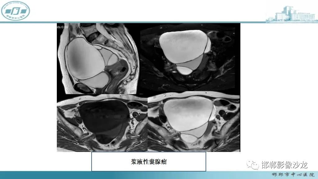影像PPT - 【PPT】卵巢甲状腺肿-28 影像PPT - 【PPT】卵巢甲状腺肿-28