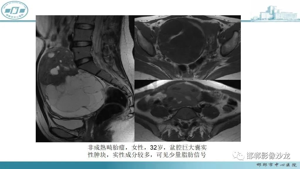 影像PPT - 【PPT】卵巢甲状腺肿-25 影像PPT - 【PPT】卵巢甲状腺肿-25