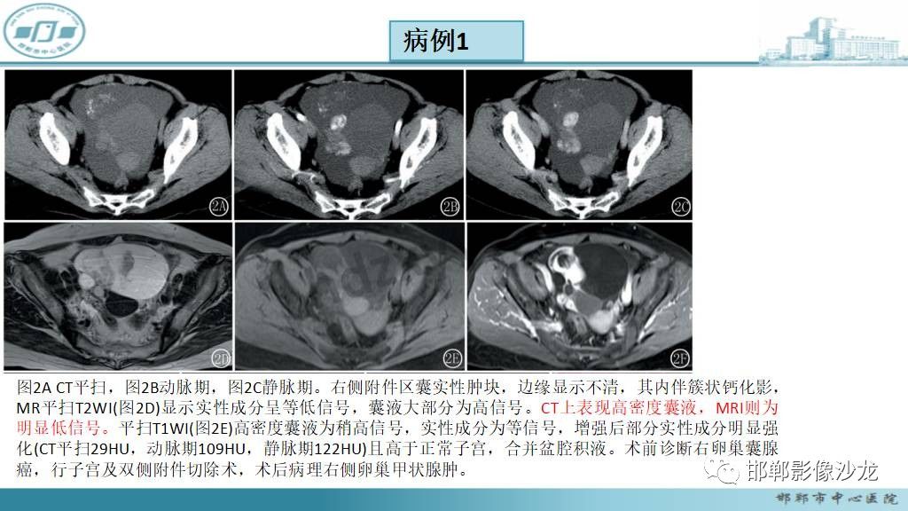 影像PPT - 【PPT】卵巢甲状腺肿-19 影像PPT - 【PPT】卵巢甲状腺肿-19