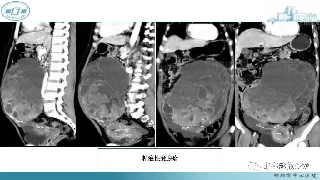 影像PPT - 【PPT】卵巢甲状腺肿-29 影像PPT - 【PPT】卵巢甲状腺肿-29