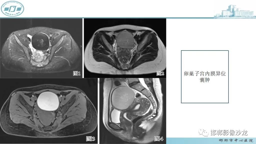 影像PPT - 【PPT】卵巢甲状腺肿-35 影像PPT - 【PPT】卵巢甲状腺肿-35