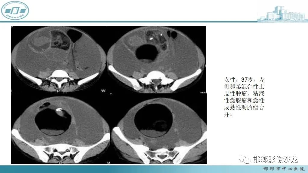 影像PPT - 【PPT】卵巢甲状腺肿-41 影像PPT - 【PPT】卵巢甲状腺肿-41