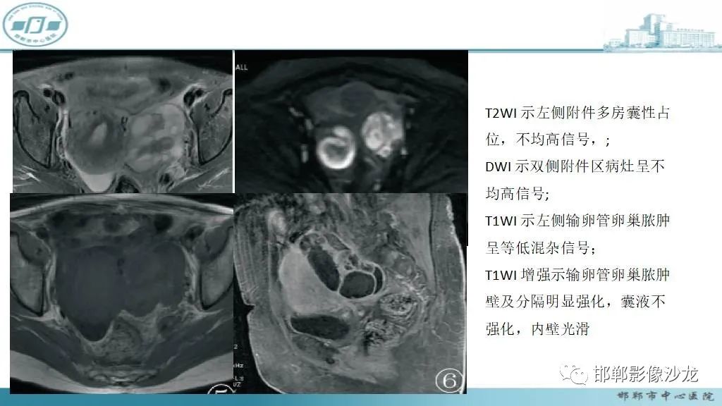 影像PPT - 【PPT】卵巢甲状腺肿-39 影像PPT - 【PPT】卵巢甲状腺肿-39
