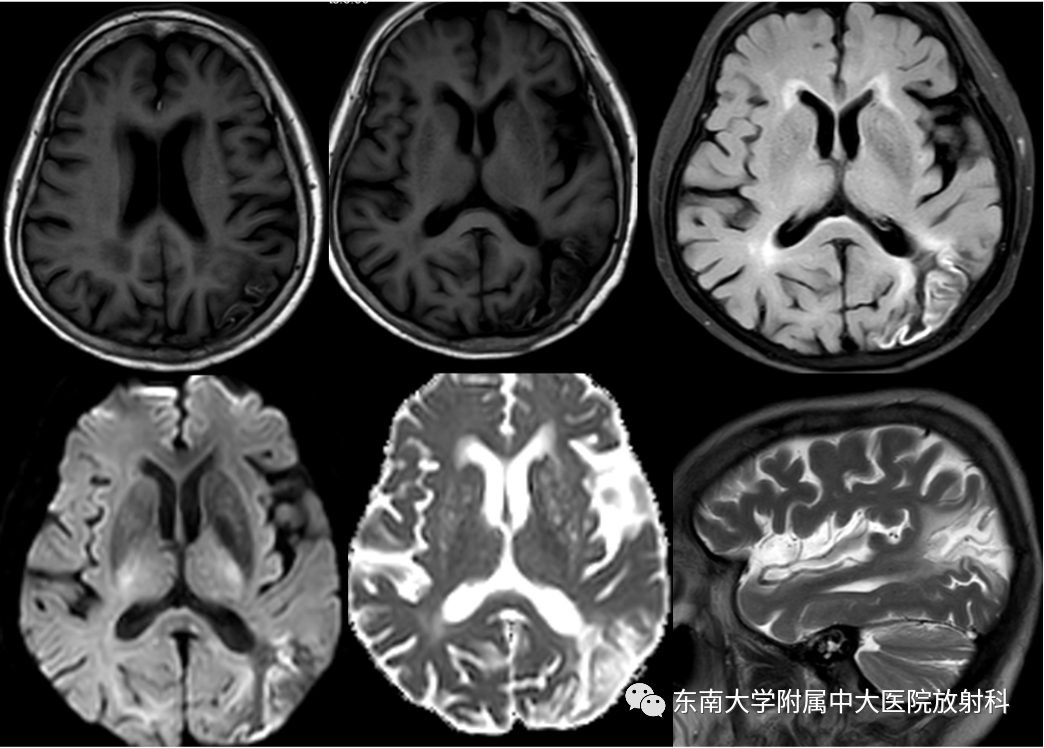 影像PPT - 【PPT】脑皮质层状坏死-2
