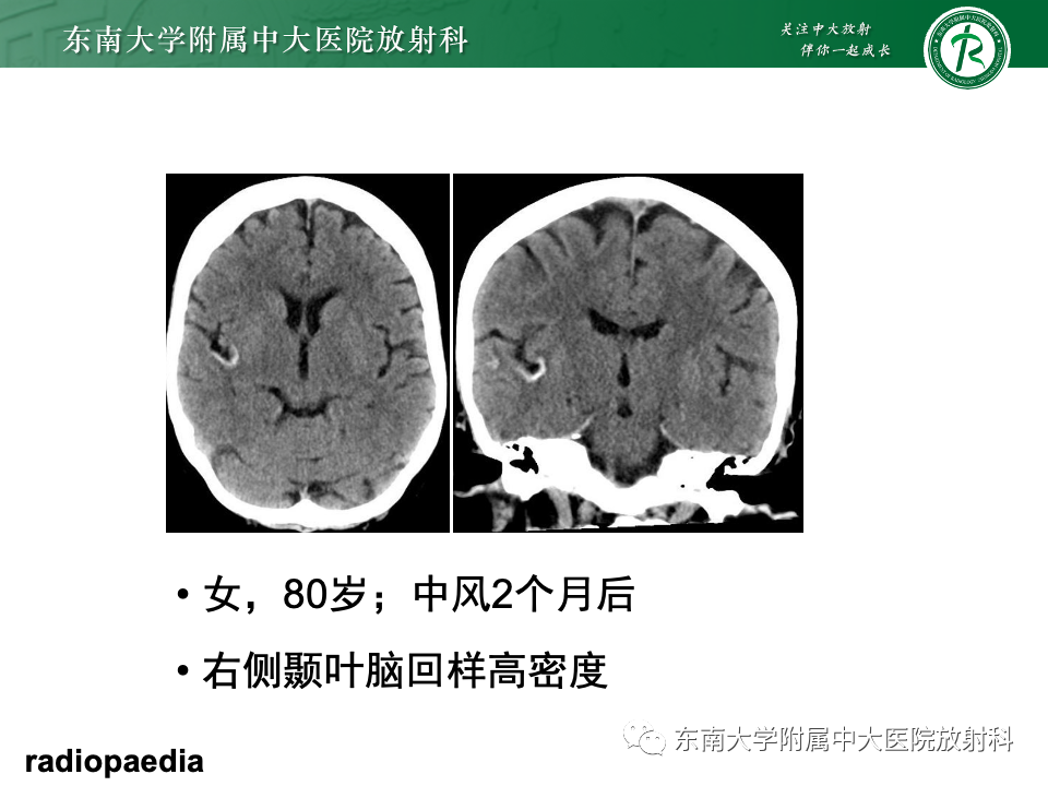 影像PPT - 【PPT】脑皮质层状坏死-13