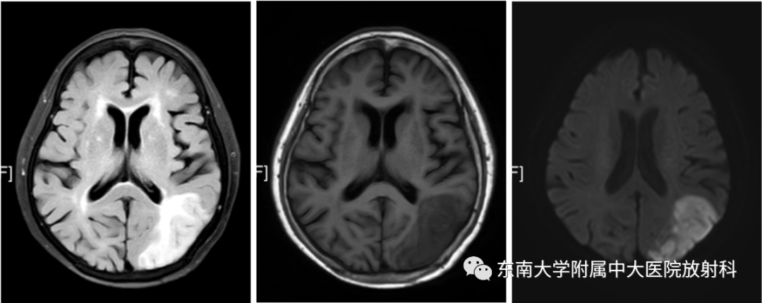 影像PPT - 【PPT】脑皮质层状坏死-1