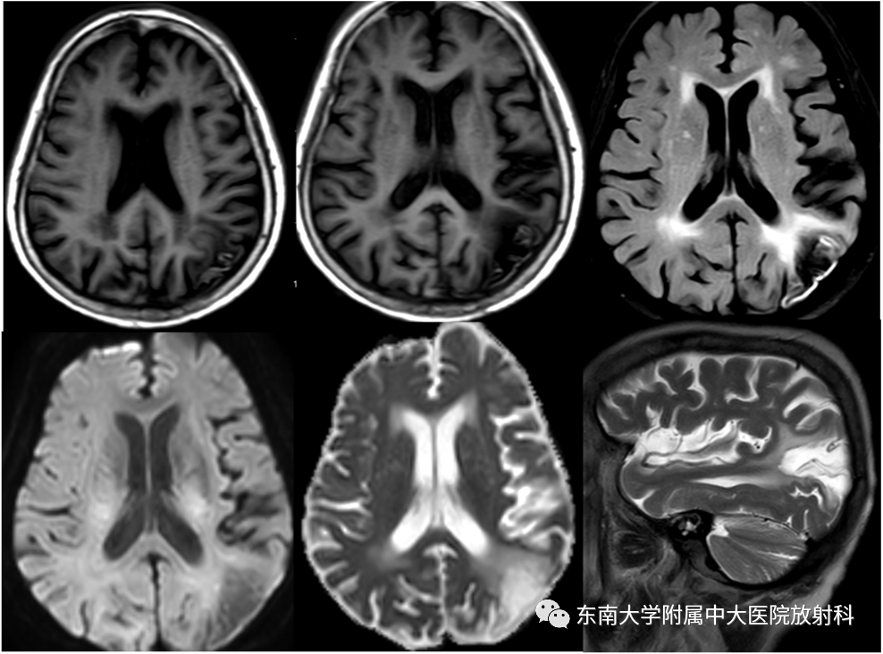 影像PPT - 【PPT】脑皮质层状坏死-3