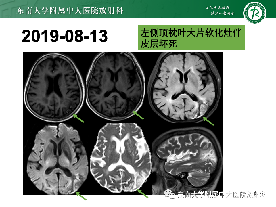 影像PPT - 【PPT】脑皮质层状坏死-7