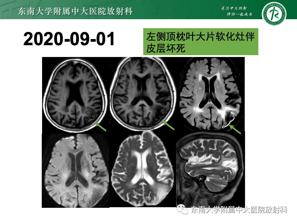 影像PPT - 【PPT】脑皮质层状坏死-8