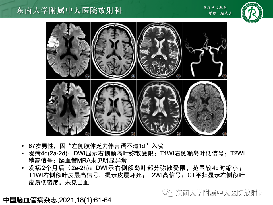 影像PPT - 【PPT】脑皮质层状坏死-15