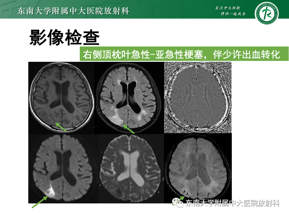 影像PPT - 【PPT】脑皮质层状坏死-19