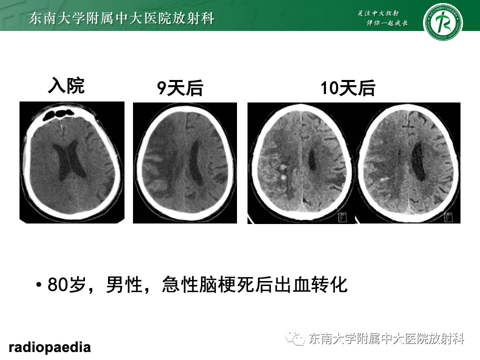 影像PPT - 【PPT】脑皮质层状坏死-22