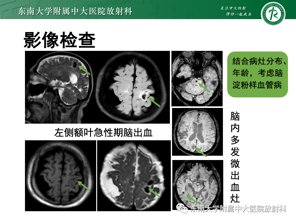 影像PPT - 【PPT】脑皮质层状坏死-25
