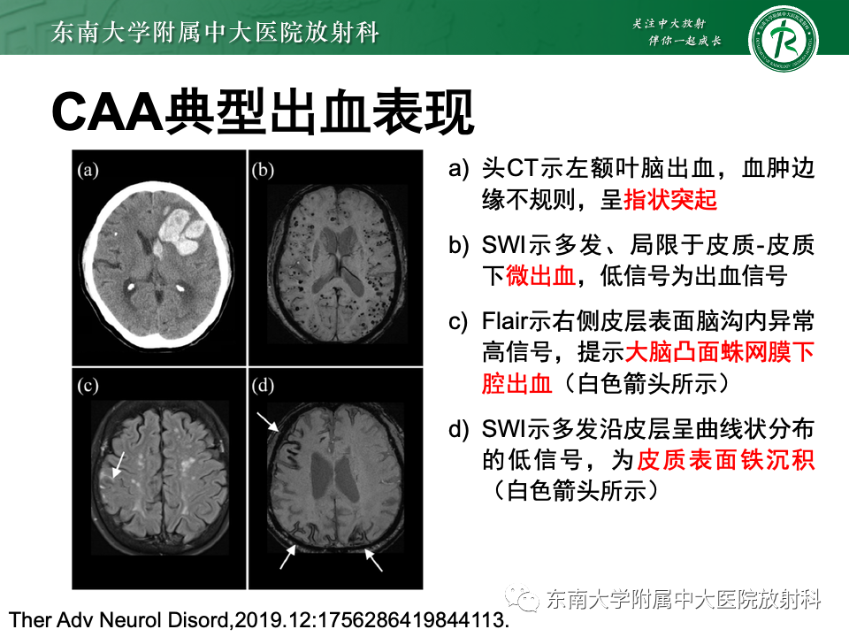 影像PPT - 【PPT】脑皮质层状坏死-28