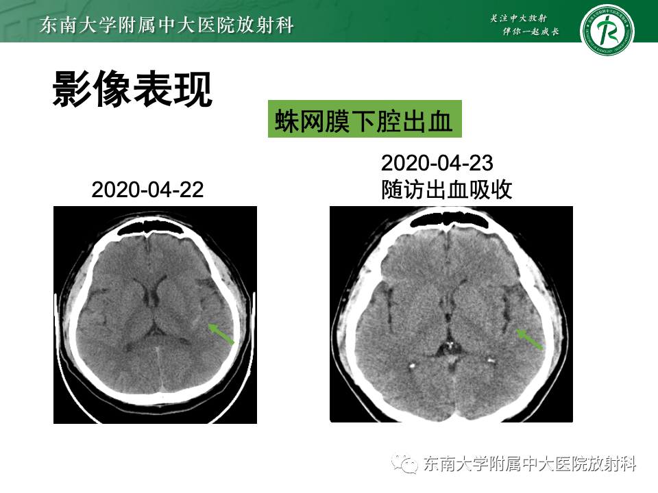 影像PPT - 【PPT】脑皮质层状坏死-32